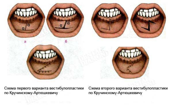 Короткая Уздечка Губы Фото