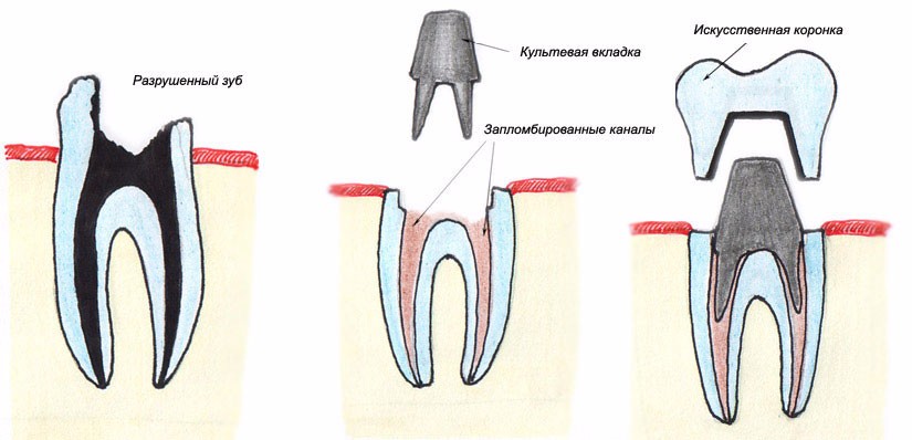 Как ставят коронку на зуб фото Восстановление зубов